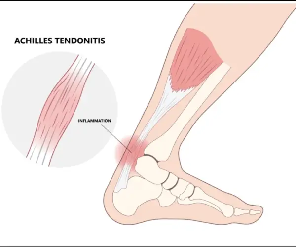 Injured ?Does rest and ice help you recover?
